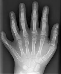 X-Ray of Polydactyly: By en:User:Drgnu23, http://commons.wikimedia.org/wiki/File%3APolydactyly_01_Lhand_AP.jpg